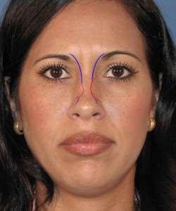 Abnormal contour involving the middle vault of the nose