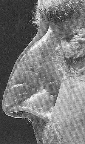 Dorsal hump Projection Rotation Nasofrontal Angle Columella Rhinoplasty