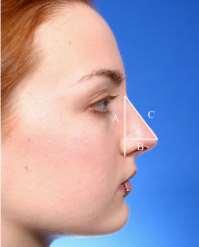 A deficient menton causes nose to appear