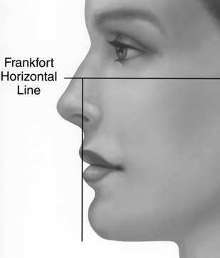 Drop Frankfort perpendicular line from vermillion of lower lip