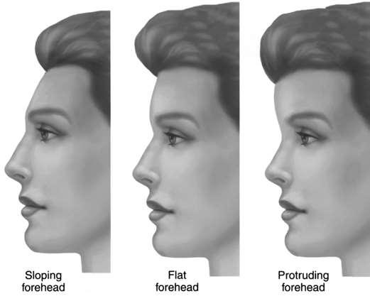 A forehead that slopes posteriorly from the brow to the hairline tends to exaggerate the appearance of nasal length and projection.