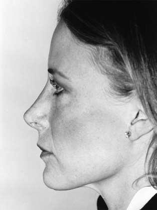 exploration of the nasal tip