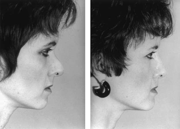 Figure 32 4 (A) Patient requesting revision rhinoplasty following overaggressive procedure carried out elsewhere.