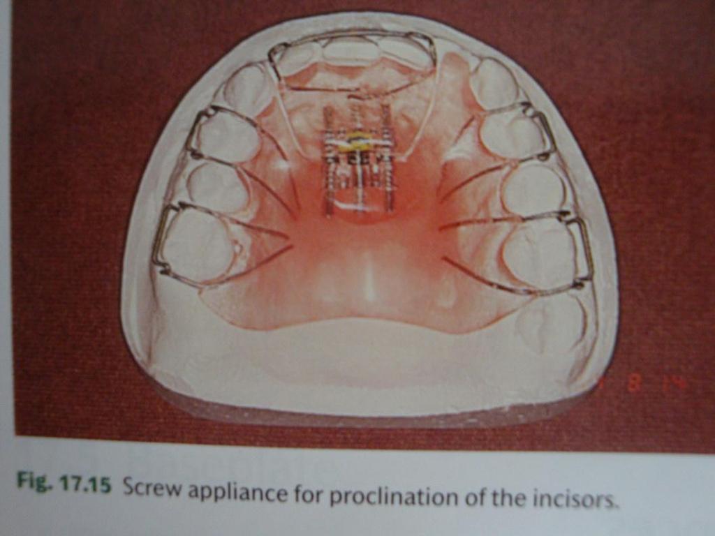 labially of upper incisor(s)