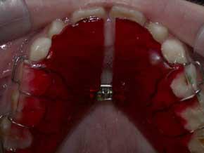 Screw appliance to expand upper arch For moving blocks of teeth Activation: a
