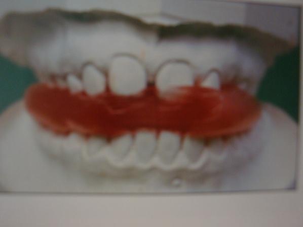 Recent set of dental cast