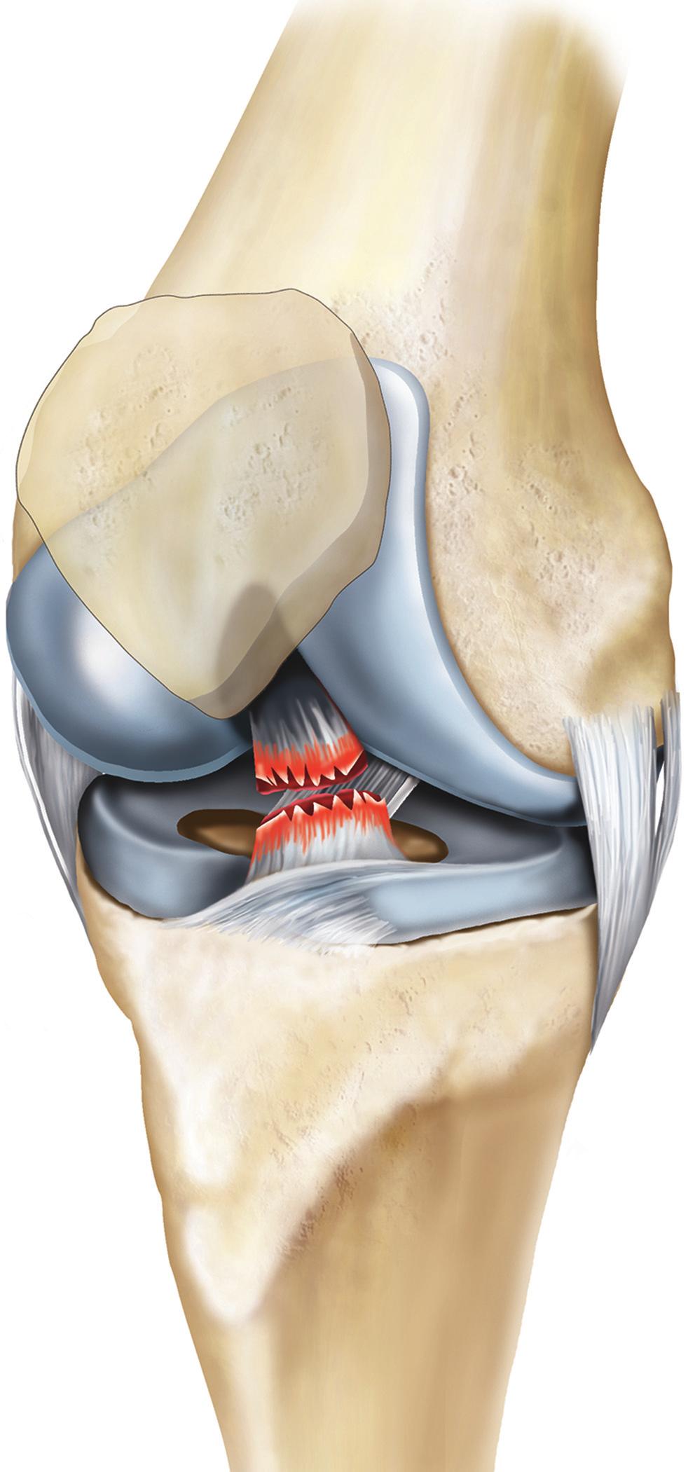 What is the anterior cruciate ligament? The anterior cruciate ligament (ACL) is one of the important ligaments that stabilise your knee.