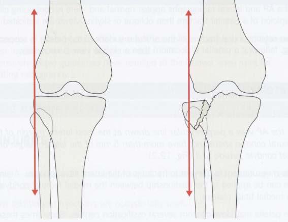 Knee Tibia Plateau Fracture Treatment Long POP