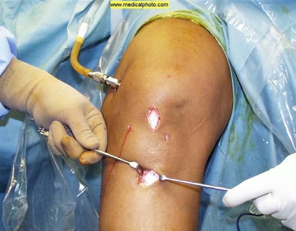 Soft Tissue Injury Locked Knee Full extension blocked.
