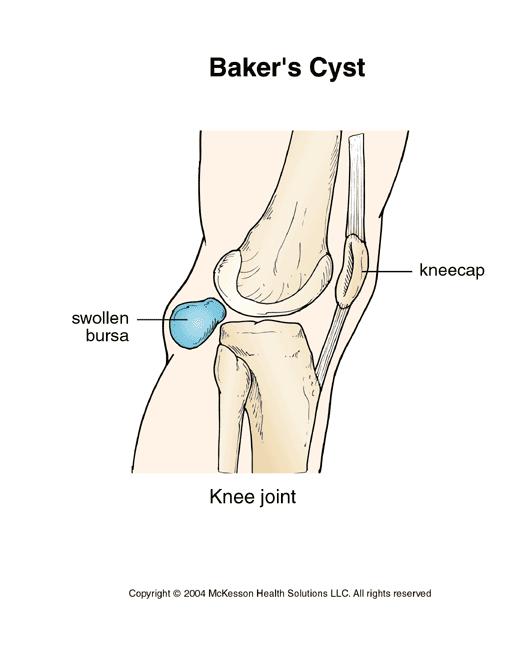 Knee problems not to be missed Baker s Cyst Osteoarthritis Septic Arthritis