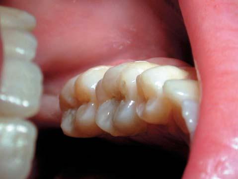 Figure 6: Occlusal pit and fissure caries on the lower left first molar which is too extensive for