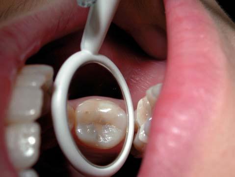 Figure 8: During the cavity preparation, the last 1 mm of leathery infected caries overlying the