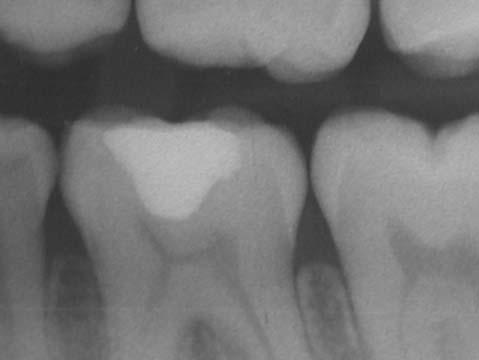 Figure 11: Three months later the Patient was recalled and the temporary cement was removed, taking great care not to remove any tooth tissue.