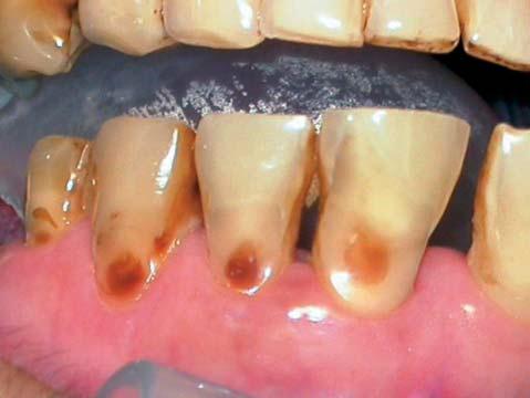 However it is notable that an enamel shaded flowable composite resin had been used and therefore the remineralised lesion beneath is partly showing through.