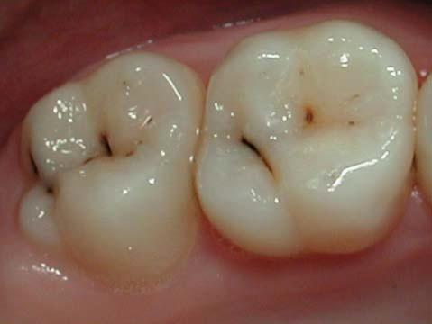 Although they are now arrested lesions, it is worth noting that that some Dentists might be confused with this discoloured appearance and mistakenly think this might need drilling and filling.