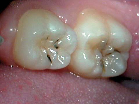 Therefore, it is recommended that each pit and fissure lesion with any dentinal involvement should be retreated with the HealOzone after 4 weeks, prior to the placement of a flowable composite resin.