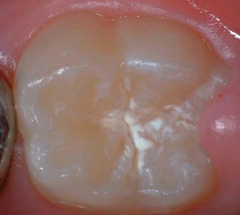 Figure 4: White discoloration of a fissure system fissure sealing amongst practitioners, because there was a fear that caries could develop further beneath the sealant.