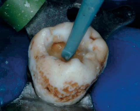 Since the length of the Fissurotomy bur assists in limiting its penetration to the depth of the enamel, it is unlikely that this step will cause any patient discomfort.