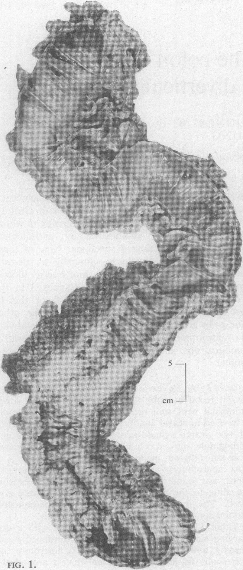 FIG. 2. Gut: first published as 10.1136/gut.9.1.7 on 1 February 1968. Downloaded from http://gut.bmj.com/ FIG. 1. Case 1: surgical specimen of descending and sigmoid colon.