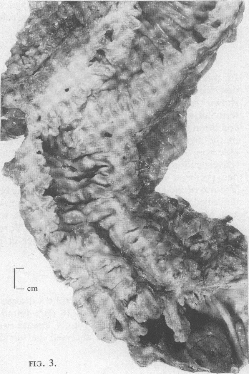 Case 1: close-up ofsigmoidpart offig. 1 showing fibromuscular thickening of the bowel wall extending into the pericolic fat.