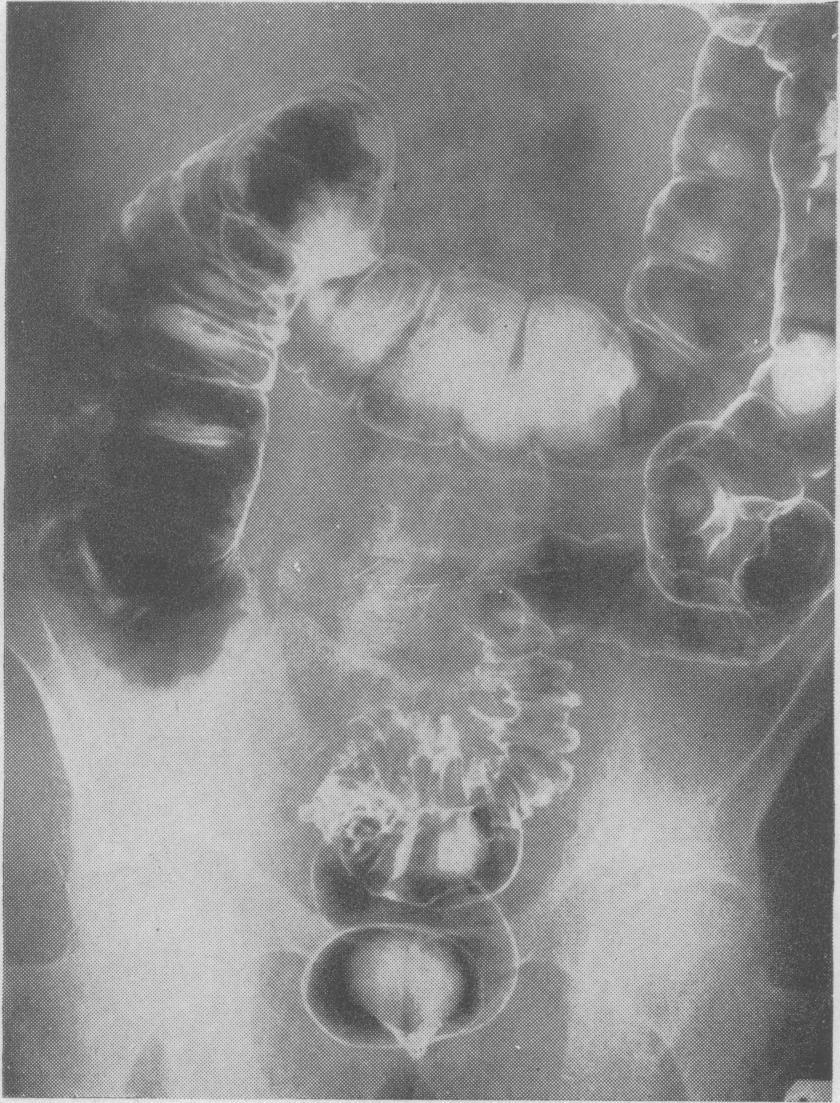 Crohn's disease of the colon and its distinction from diverticulitis Case 2 A 55-year-old man was referred to St.