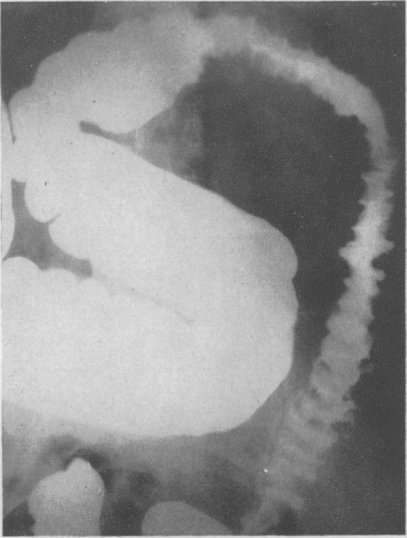 Bleeding with defaecation had occurred at the onset of his symptoms but he did not complain of any change of bowel habit or of any significant abdominal pain. Barium enema (Fig.