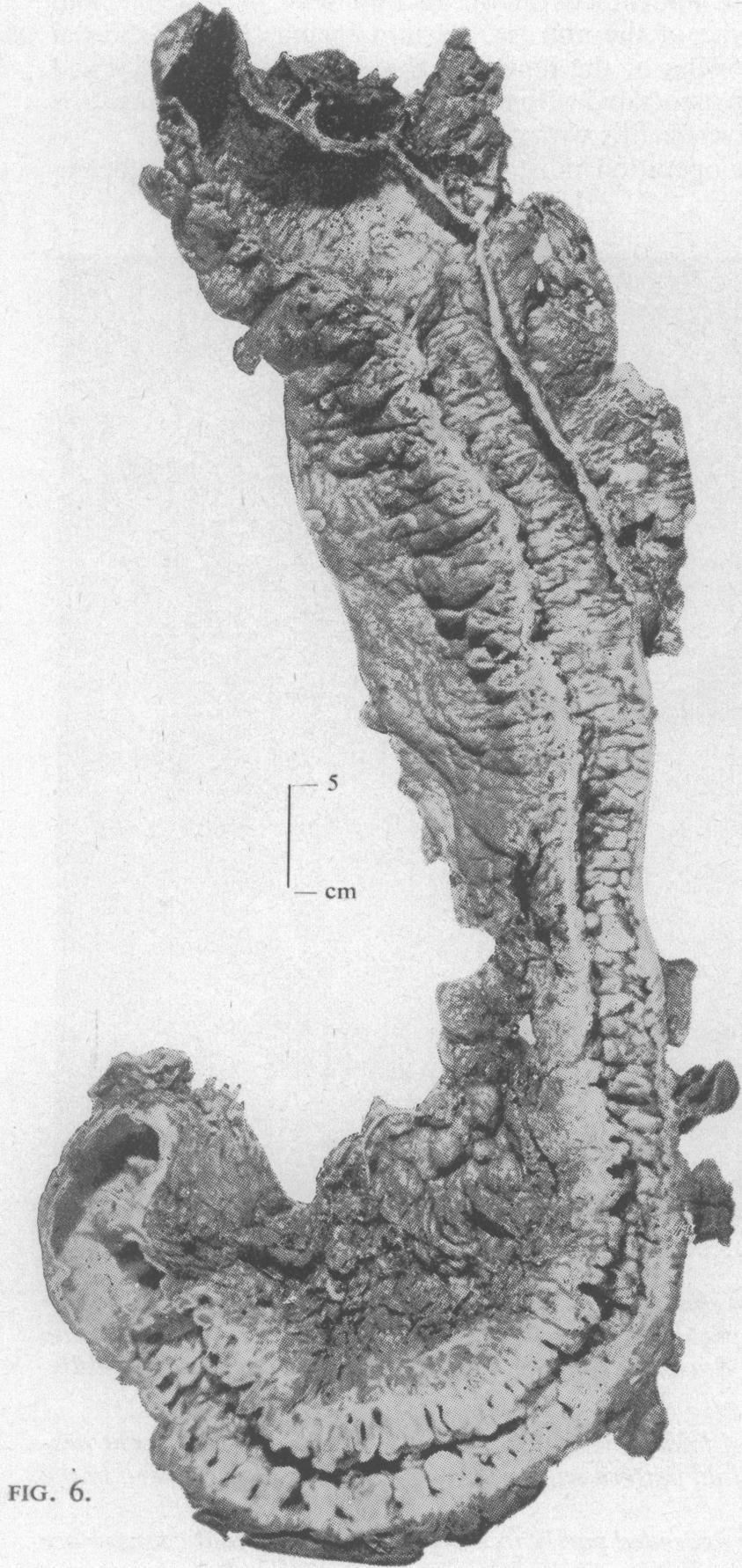 10 G. T. Schmidt, J. E. Lennard-Jones, B. C. Morson, and A. C. Young volved by an inflammatory process causing marked thickening of the bowel wall with oedema of the mesentery.