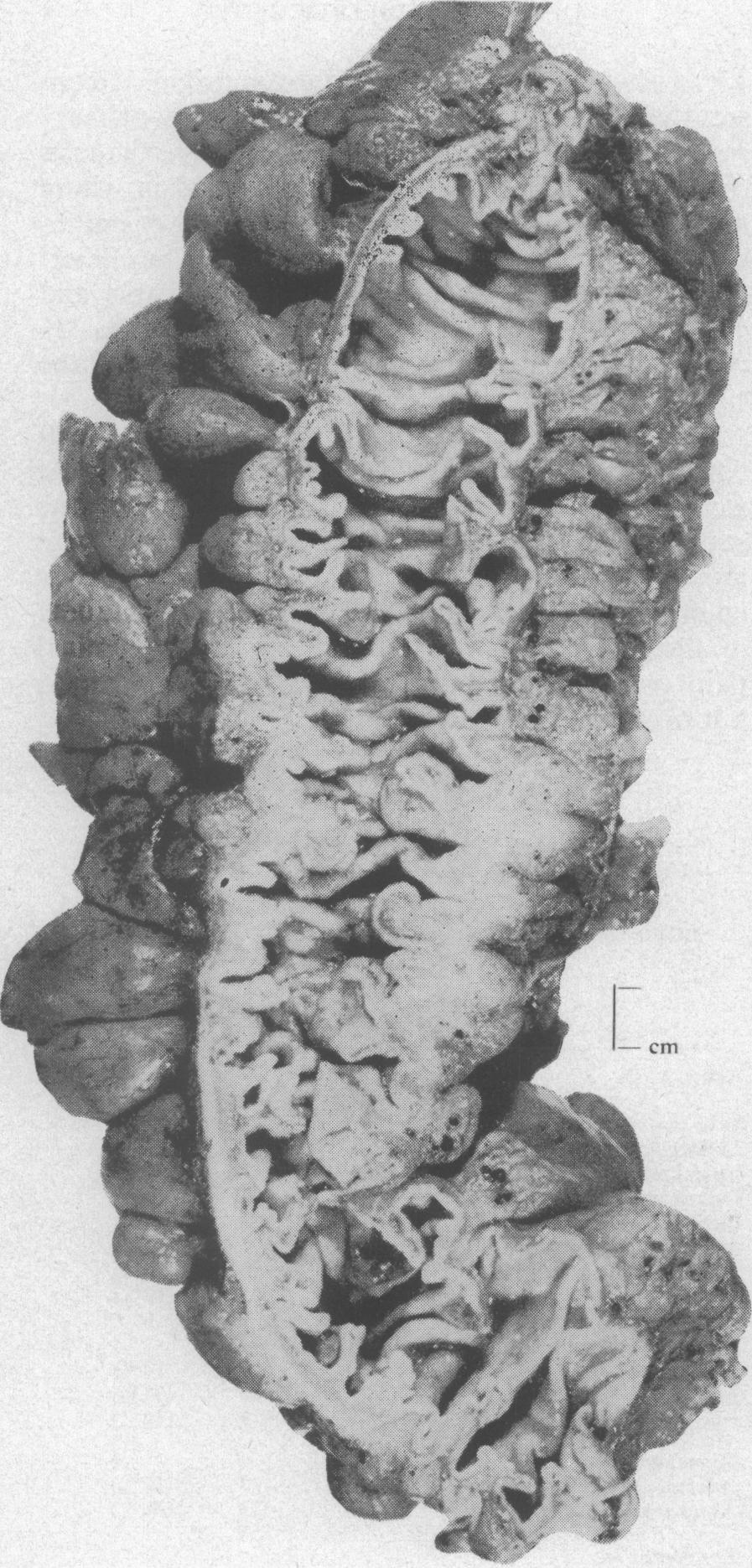 Crohn's disease of the colon and its distinction from diverticulitis FIG. 8.