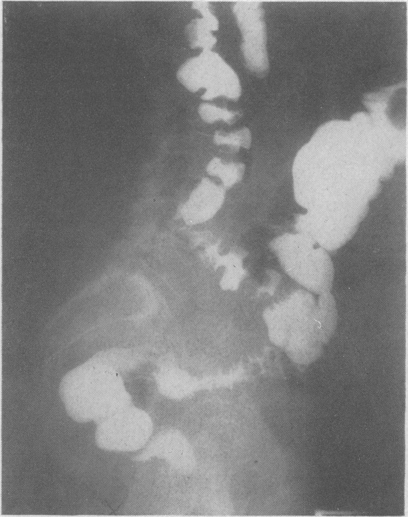 Crohn's disease of the colon and its distinction from diverticulitis FIG. 1 0. FIG. 1 1. FIG. 10. Case 6: the proximal sigmoid shows an asymmetrical fold pattern suggestive of diverticular disease.
