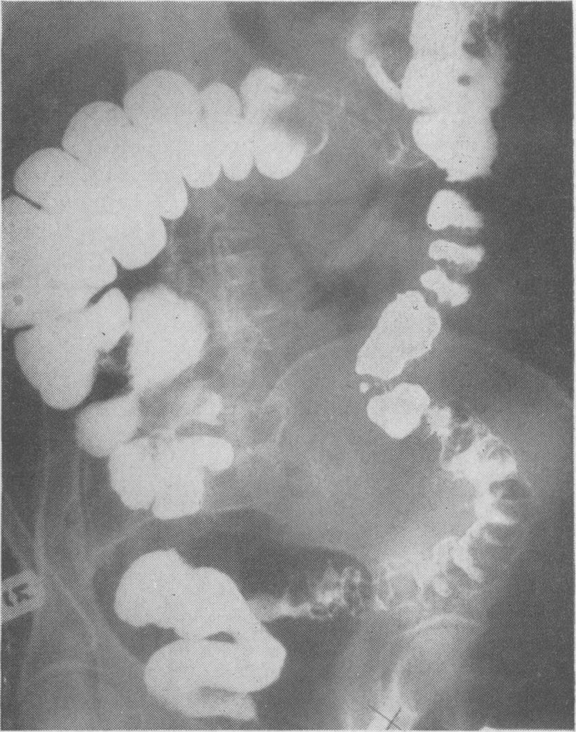 The appearances in the distal segment are due to Crohn's disease; no diverticula were seen in the specimen. FIG. 11. Case 6: enema via distal loop ofcolostomy.