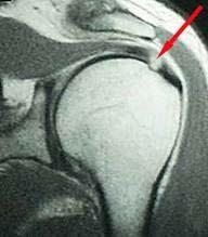 Role of MRI in Rotator Cuff Tears Partial vs.