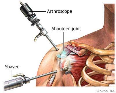 Shoulder Arthroscopy Joint is viewed using a camera, inserted through a small incision Other instruments are inserted through additional small incisions The