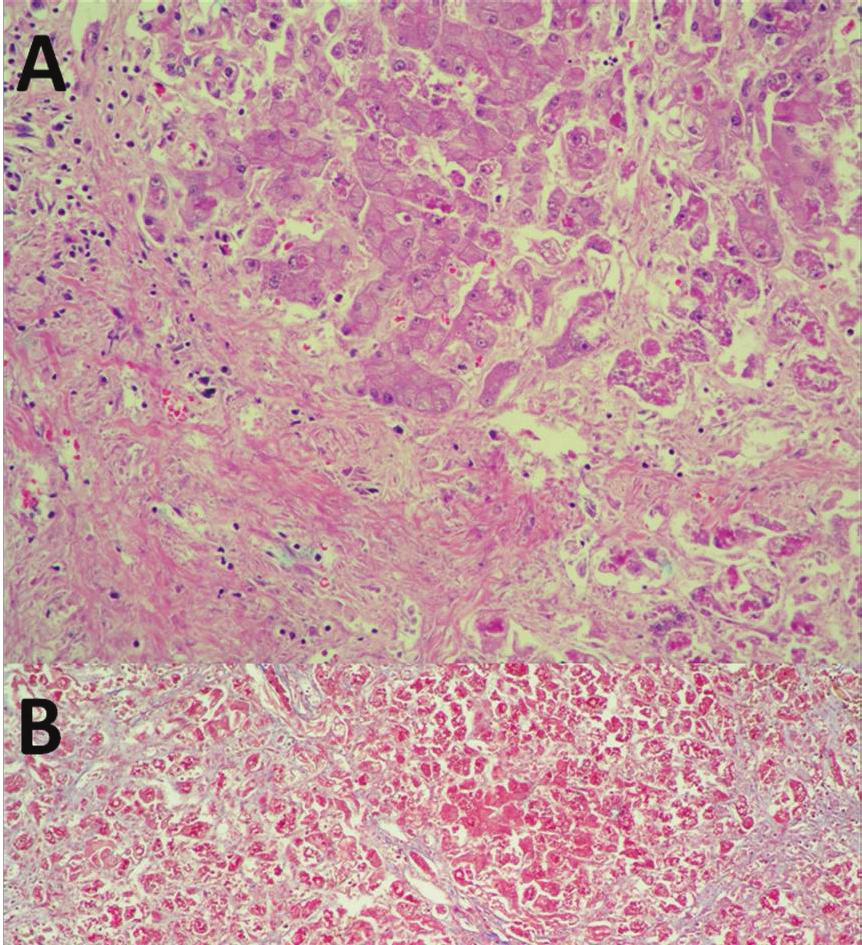 THAI J 108 Fatal Acute-on-Chronic Liver Failure from Amiodarone Toxicity GASTROENTEROL 2014 Figure 3.