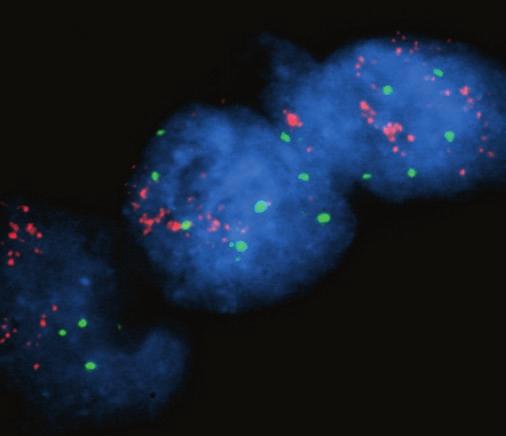 Anatomic Pathology / Original Article Image 4 Interphase nuclei showing HER2 amplification (red) and multiple copies of centromere 17 (green) after 1 hour ( 1,000).
