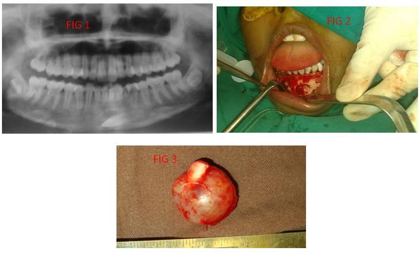 FIGURE LEGENDS: Fig 1. Orthopantomogram Fig 2. Elevation of flap reveals the cyst with impacted canine tooth.