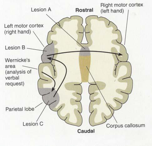Callosal apraxia Damage: Anterior corpus callosum Apraxia of the left limb Sympathetic apraxia Damage: Left frontal lobe