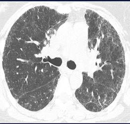 Respiratory symptoms/lung disease Shortness of