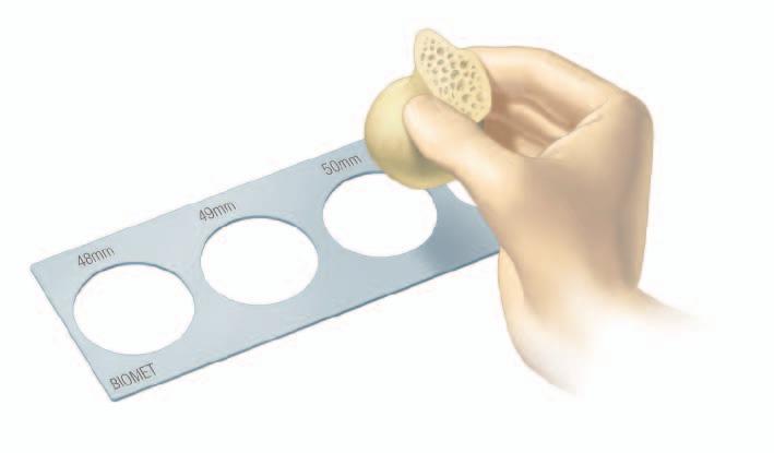 Operative Technique 1. Surgical exposure The Scan Bi-Polar component can be implanted using any of the standard approaches for total hip replacement.