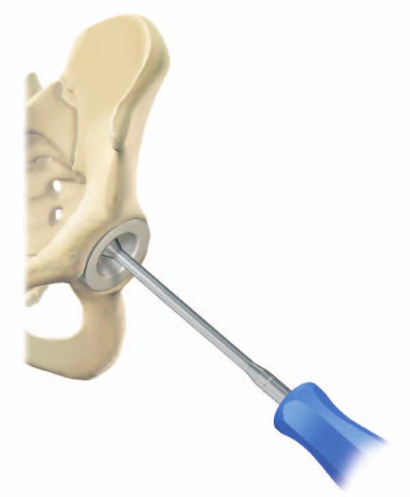 The first method utilises the resected anatomic femoral head with the head gauges.