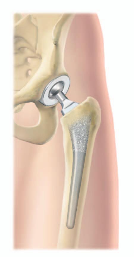 A Bi-Polar assembly is finally seated in position by means of a gentle tap utilising the femoral head impaction device and mallet (Figure 7).