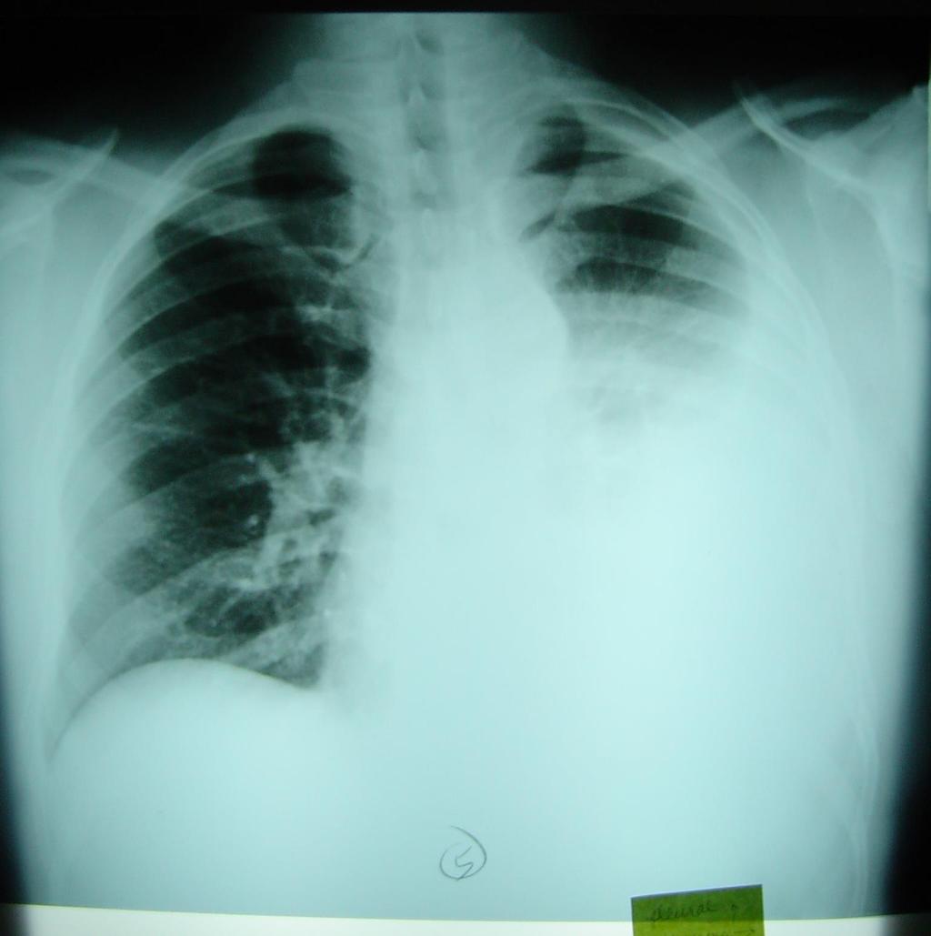 Tuberculosis Elimination: The