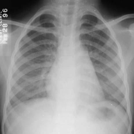 Case #21 8-year old girl, recently arrived from Haiti was evaluated at the DOH for a 12 mm TST reaction There were no symptoms of TB disease and PE was normal A chest