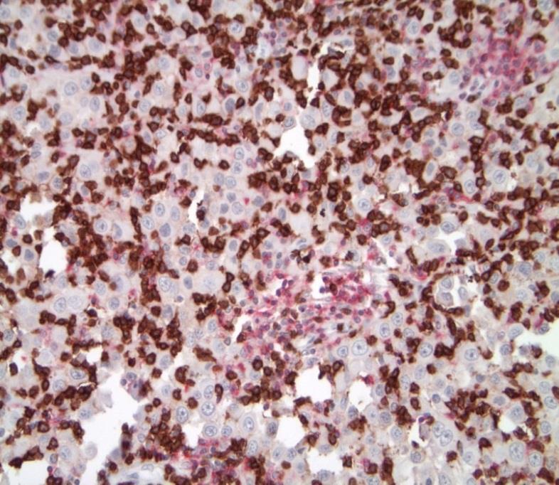 Tumor TIL by IHC (N=24): CD8+ T Cells TIL Median Δ
