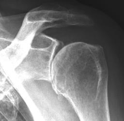 Conclusions 26/427 patients with creation of a humeral window No malunion