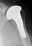 posttraumatic arthritis, uncemented components increased