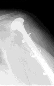 Why Consider Short Stems Decrease Intraoperative Humerus Fractures (1.