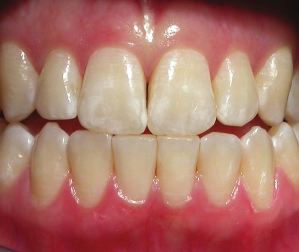reverse white spots, GC Tooth Mousse Plus with RECALDENT (CPP-ACP) offers