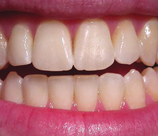 When applied regularly, GC Tooth Mousse Plus helps create a more