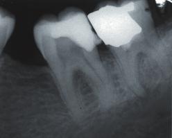 Radiographic examination showed normal periodontium apparatus [Figures 1-4].
