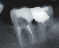 The tooth was extracted after two months and histological assessment was performed.